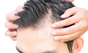 male-pattern-baldness-treatment